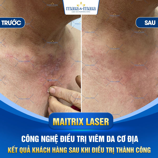 trị viêm da toàn thân