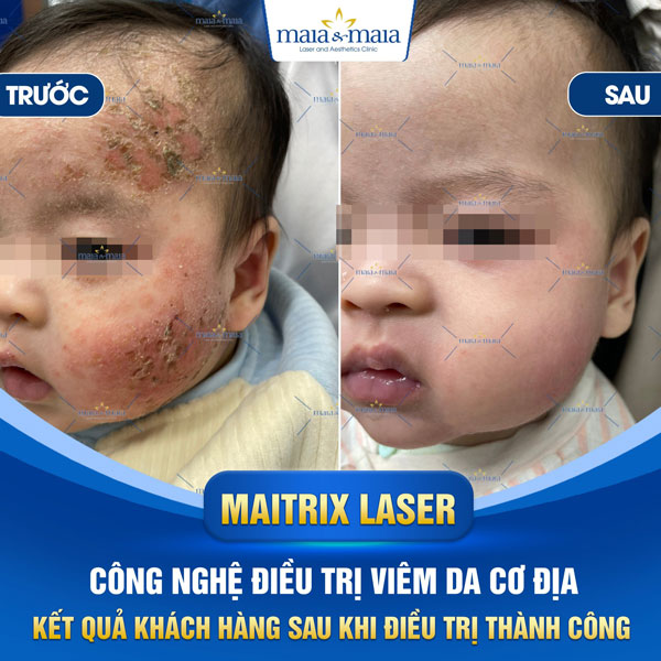 trị viêm da trẻ em