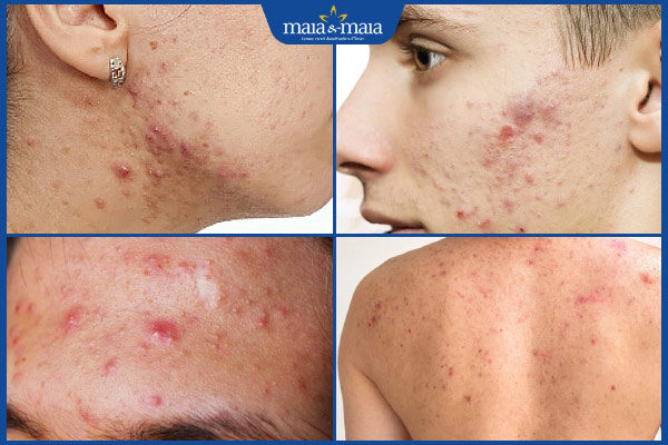 đối tượng bắn laser